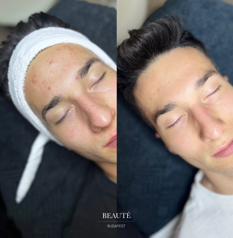 Tisztító arckezelés